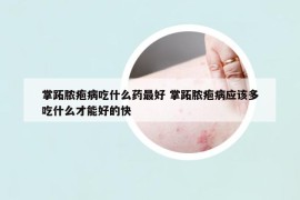 掌跖脓疱病吃什么药最好 掌跖脓疱病应该多吃什么才能好的快