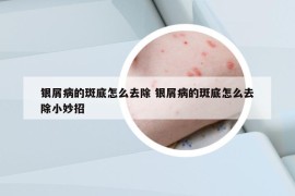 银屑病的斑底怎么去除 银屑病的斑底怎么去除小妙招