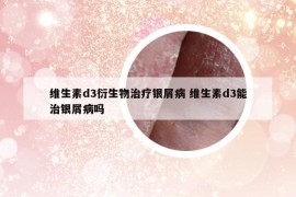 维生素d3衍生物治疗银屑病 维生素d3能治银屑病吗