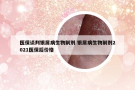 医保谈判银屑病生物制剂 银屑病生物制剂2021医保后价格