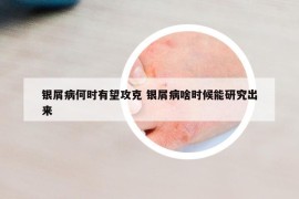 银屑病何时有望攻克 银屑病啥时候能研究出来