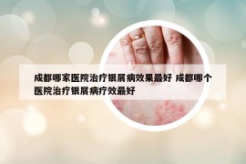 成都哪家医院治疗银屑病效果最好 成都哪个医院治疗银屑病疗效最好