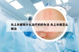 头上长癣有什么治疗的好办法 头上长癣怎么根治