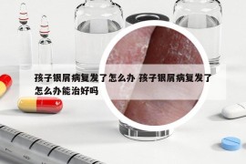 孩子银屑病复发了怎么办 孩子银屑病复发了怎么办能治好吗