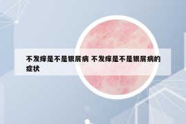 不发痒是不是银屑病 不发痒是不是银屑病的症状