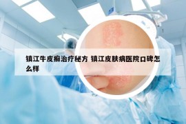 镇江牛皮癣治疗秘方 镇江皮肤病医院口碑怎么样