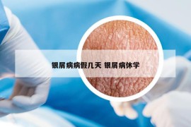 银屑病病假几天 银屑病休学