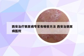 西安治疗银屑病专家有哪些方法 西安治银屑病医院