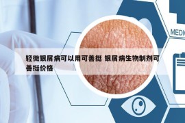 轻微银屑病可以用可善挺 银屑病生物制剂可善挺价格