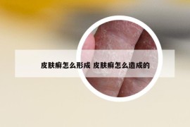 皮肤癣怎么形成 皮肤癣怎么造成的