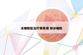 冰硼散能治疗银屑病 抹冰硼散