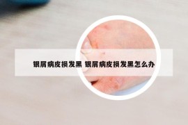 银屑病皮损发黑 银屑病皮损发黑怎么办