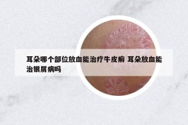 耳朵哪个部位放血能治疗牛皮癣 耳朵放血能治银屑病吗