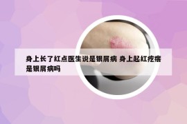 身上长了红点医生说是银屑病 身上起红疙瘩是银屑病吗