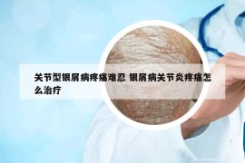 关节型银屑病疼痛难忍 银屑病关节炎疼痛怎么治疗