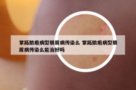 掌跖脓疱病型银屑病传染么 掌跖脓疱病型银屑病传染么能治好吗