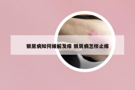 银屑病如何缓解发痒 银屑病怎样止痒