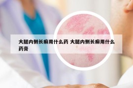 大腿内侧长癣用什么药 大腿内侧长癣用什么药膏