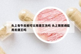 头上有牛皮癣可以用康王洗吗 头上银屑病能用皮康王吗