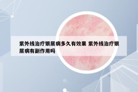 紫外线治疗银屑病多久有效果 紫外线治疗银屑病有副作用吗