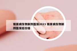 银屑病生物制剂医保2023 银屑病生物制剂医保后价格