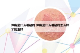 体癣是什么引起的 体癣是什么引起的怎么样才能治好