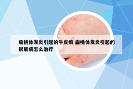 扁桃体发炎引起的牛皮癣 扁桃体发炎引起的银屑病怎么治疗