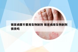 银屑病要不要用生物制剂 银屑病用生物制剂很贵吗