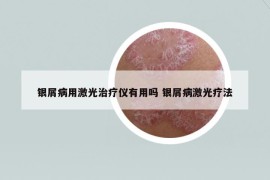 银屑病用激光治疗仪有用吗 银屑病激光疗法