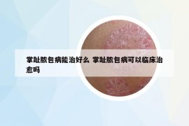 掌趾脓包病能治好么 掌趾脓包病可以临床治愈吗