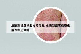 点滴型银屑病脱皮后发红 点滴型银屑病脱皮后发红正常吗