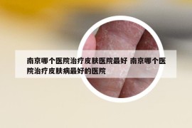 南京哪个医院治疗皮肤医院最好 南京哪个医院治疗皮肤病最好的医院