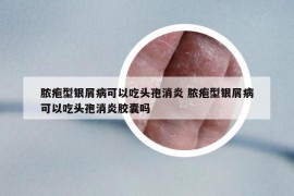 脓疱型银屑病可以吃头孢消炎 脓疱型银屑病可以吃头孢消炎胶囊吗