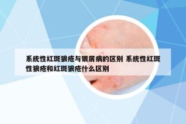 系统性红斑狼疮与银屑病的区别 系统性红斑性狼疮和红斑狼疮什么区别