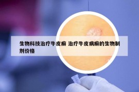 生物科技治疗牛皮癣 治疗牛皮病癣的生物制剂价格