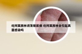 吃阿莫西林诱发银屑病 吃阿莫西林会引起真菌感染吗