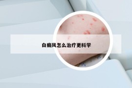 白癜风怎么治疗更科学