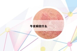 牛皮癣放什么