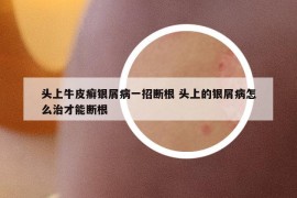 头上牛皮癣银屑病一招断根 头上的银屑病怎么治才能断根