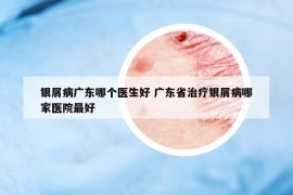 银屑病广东哪个医生好 广东省治疗银屑病哪家医院最好