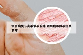 银屑病关节炎手掌手腕痛 银屑病导致手指关节疼