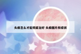 头癣怎么才能彻底治好 头癣图片和症状