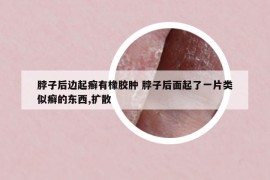 脖子后边起癣有橡胶肿 脖子后面起了一片类似癣的东西,扩散