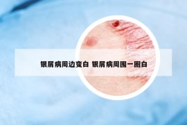 银屑病周边变白 银屑病周围一圈白