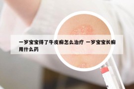 一岁宝宝得了牛皮癣怎么治疗 一岁宝宝长癣用什么药