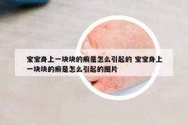 宝宝身上一块块的癣是怎么引起的 宝宝身上一块块的癣是怎么引起的图片