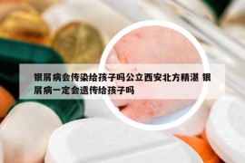 银屑病会传染给孩子吗公立西安北方精湛 银屑病一定会遗传给孩子吗