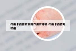 疔癣卡西甫散的附作用有哪些 疗癣卡西甫丸祛痘