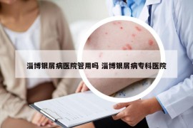 淄博银屑病医院管用吗 淄博银屑病专科医院