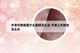 手掌长脓疱是什么原因怎么治 手掌上长脓包怎么办